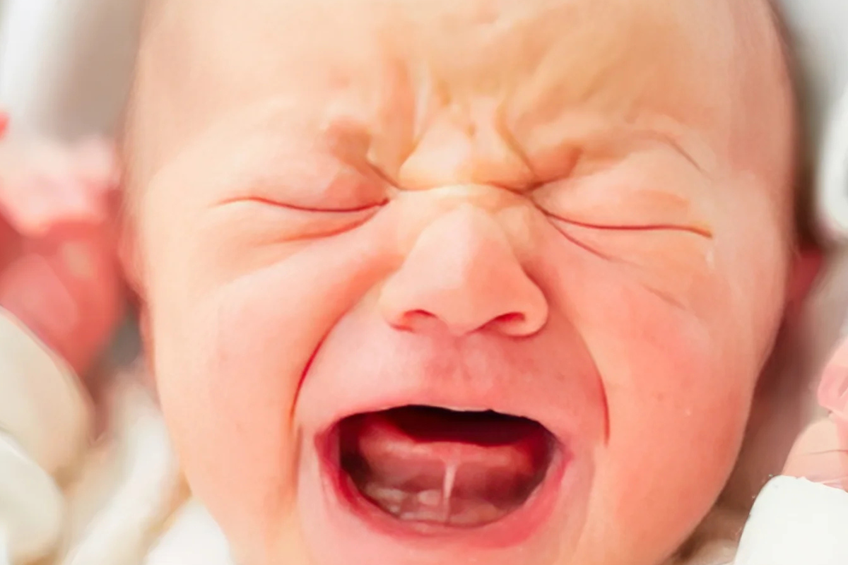 Frenillo sublingual corto y anquiloglosia